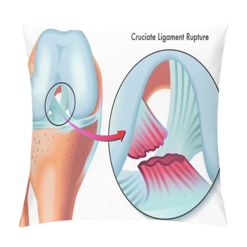 Personality  Medical Illustration Of Anterior Cruciate Ligament Rupture Pillow Covers