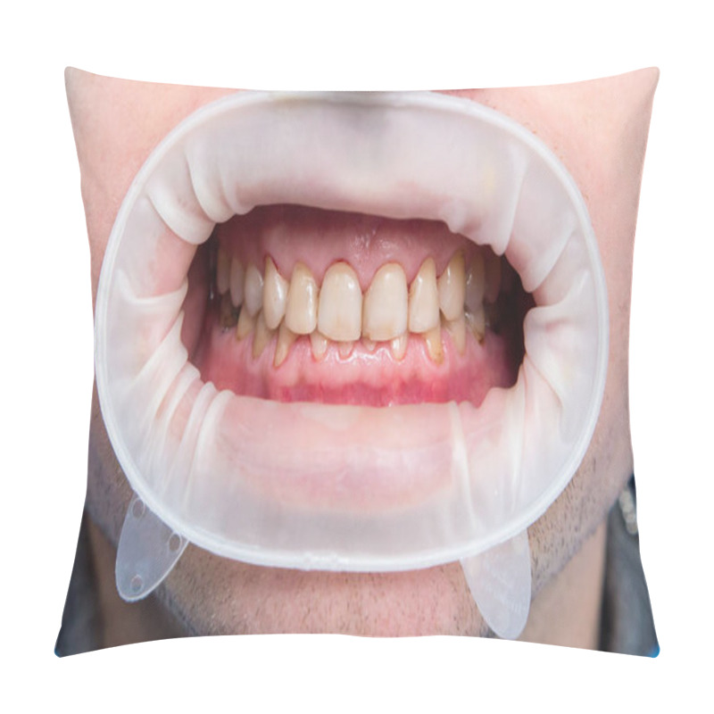 Personality  Close Up Of Dental Fluorosis Pillow Covers