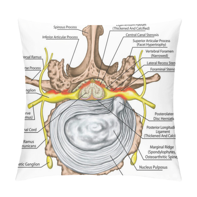 Personality  Stenosis, Lumbar Disk Herniation, Herniated Disc, Lumbar Vertebra, Osteophytes, Spondylophytes, Intervertebral Disk, Nervous System, Nerve Root, Spinal Cord, Arthrosis, Vertebra, Anatomy Of Human Skeletal And Nervous System, Superior View Pillow Covers