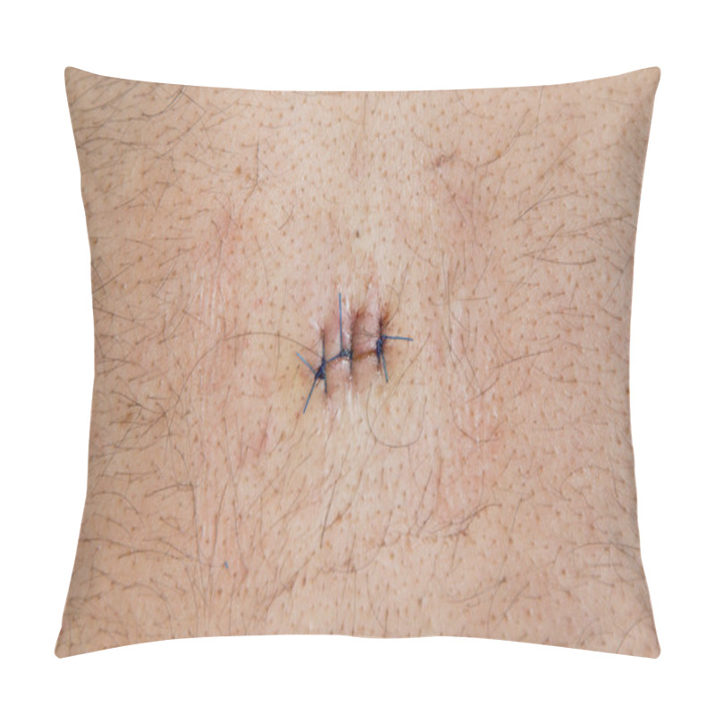 Personality  Sebaceous Epidermoid Cyst Operated Stitch On The Back Of The Male Pillow Covers