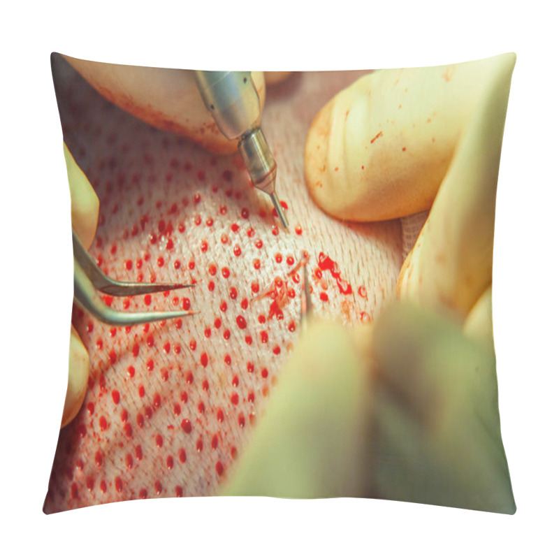 Personality  Patients Head Close-up. Baldness Treatment. Hair Transplant. Surgeons In The Operating Room Carry Out Hair Transplant Surgery. Surgical Technique That Moves Hair Follicles From A Part Of The Head. Pillow Covers