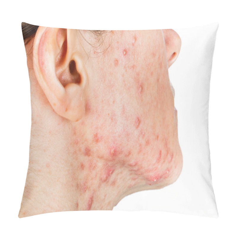 Personality   Young Girl With Skin Problem Pillow Covers