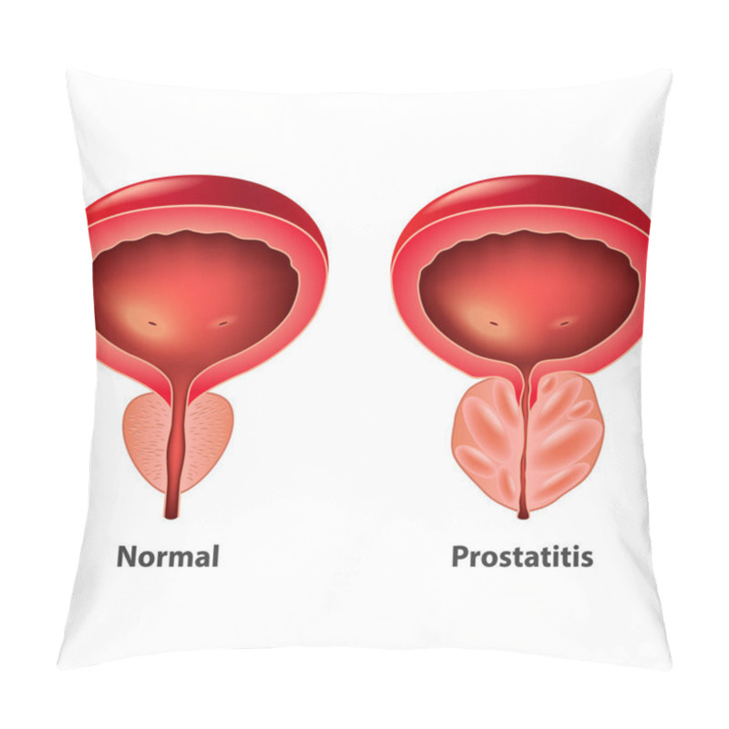 Personality  Prostatitis Normal And Inflamed Prostate Isolated Vector Photo-realistic Illustration Pillow Covers