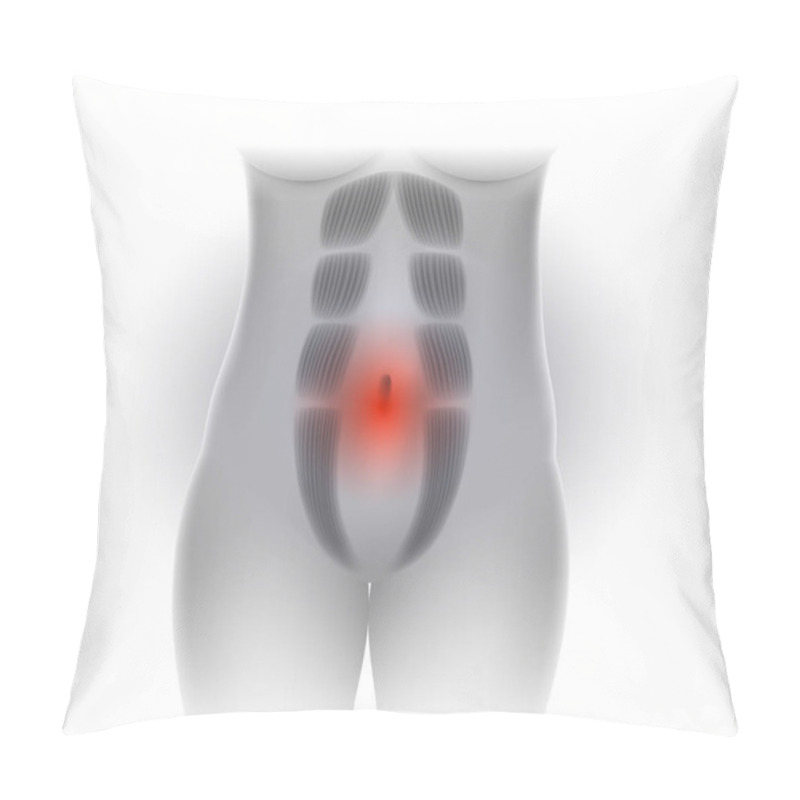 Personality  Diastasis Recti Also Known As Diastasis Rectus Abdominus Or Abdominal Separation, It Is Common Among Pregnant Women And Post Birth. There Is A Gap Between The Rectus Abdominis Muscles. Pillow Covers