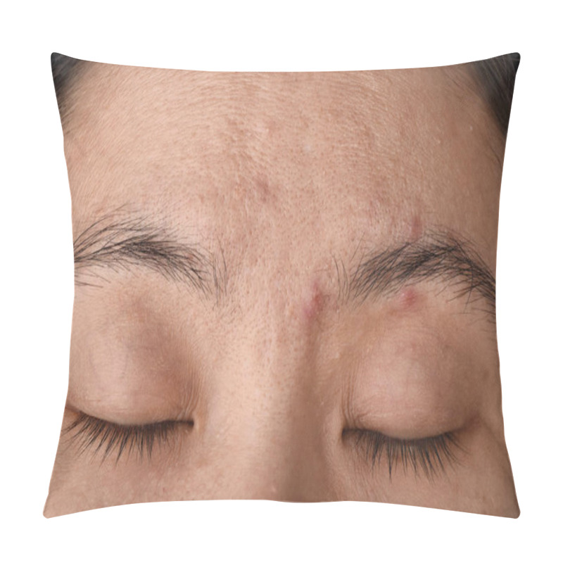 Personality  Facial Skin Problem, Aging Problem In Adult, Wrinkle, Acne Scar, Large Pore And Dark Spot, Dehydrate Skin. Pillow Covers