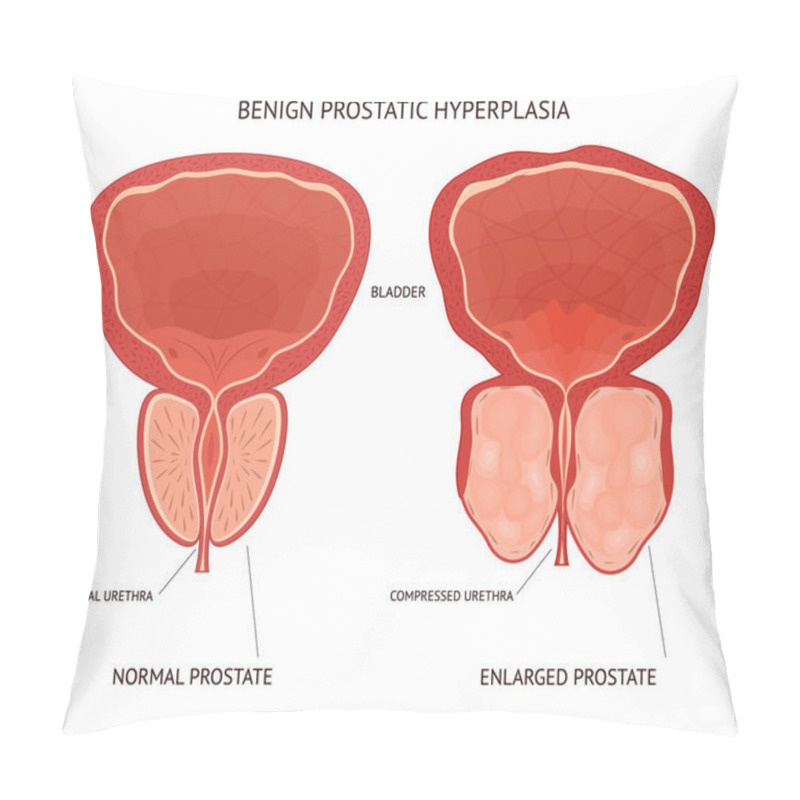 Personality  Cartoon Benign Prostatic Hyperplasia Infographics Concept Card Poster. Vector Pillow Covers