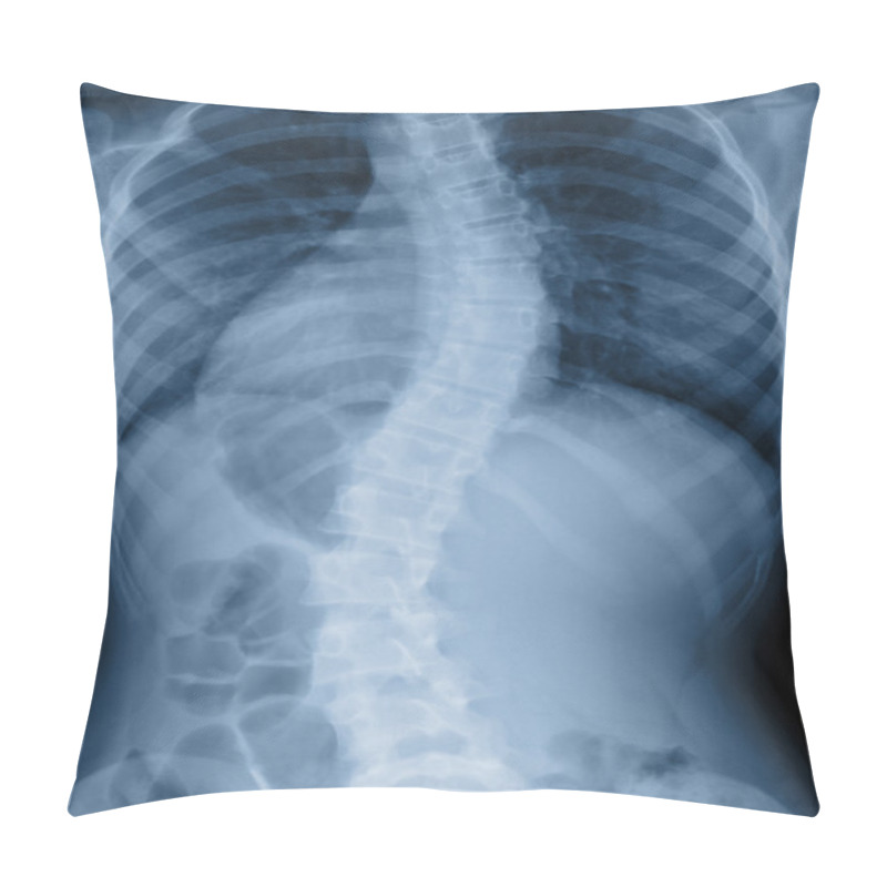 Personality  Scoliosis Film X-ray Show Spinal Bend In Teenager Patient Pillow Covers