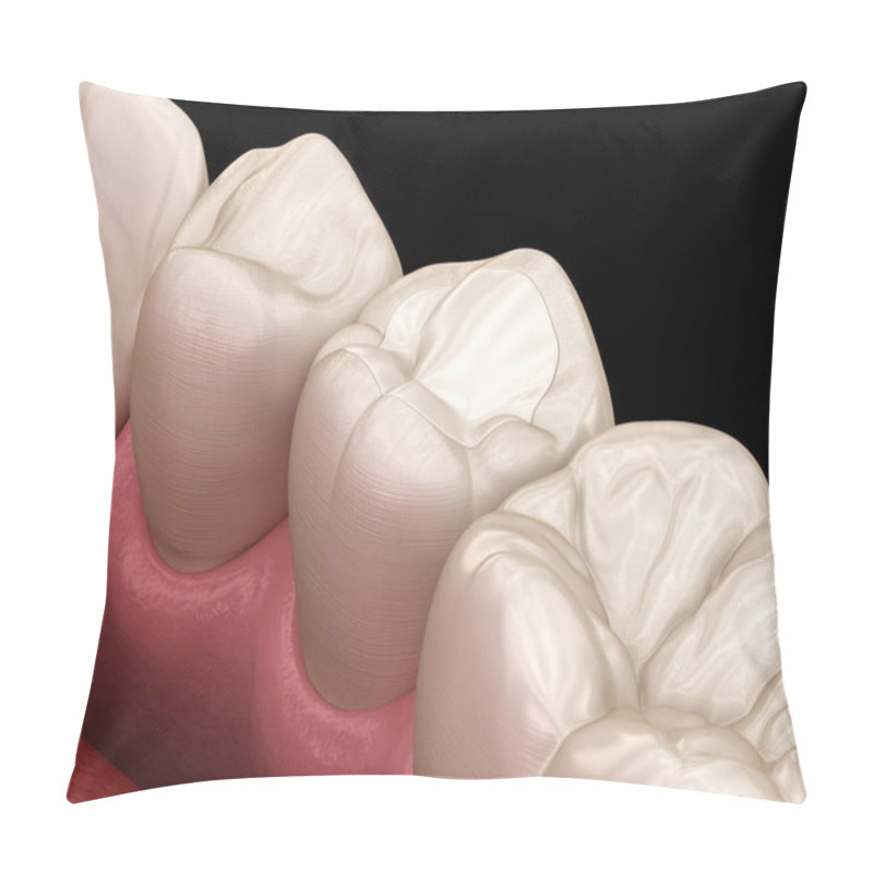 Personality  Premolar Tooth Restoration With Filling. Medically Accurate Tooth 3D Illustration. Pillow Covers