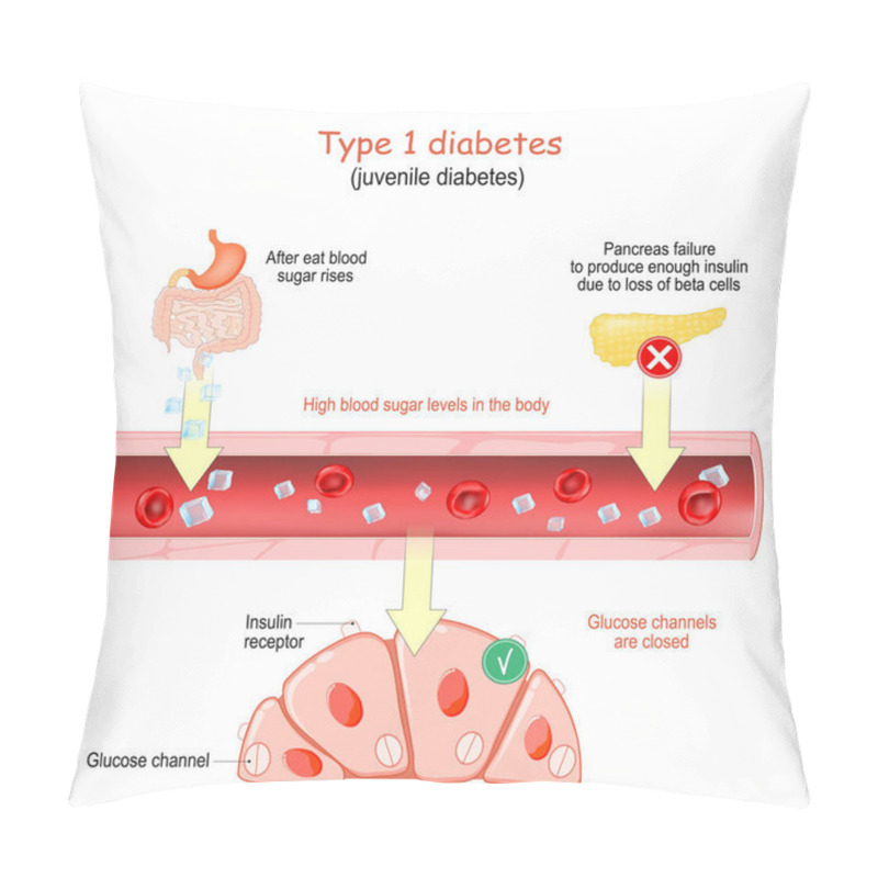 Personality  Type 1 Diabetes. Juvenile Diabetes. High Blood Sugar Levels In The Body. Glucose Channels In The Cells Are Closed. Vector Poster For Educational And Medical Use Pillow Covers