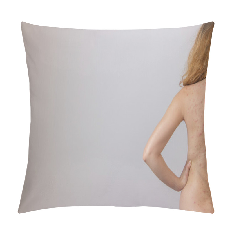 Personality  Young Girl With Acne, With Red And White Spots On The Back Pillow Covers