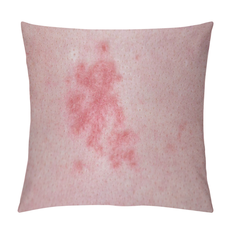 Personality  Human Skin With Red Allergic Spots, Sores Pillow Covers