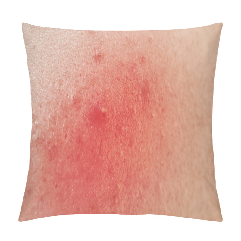 Personality  Acne Treatment Concept Pillow Covers