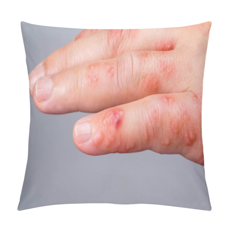 Personality  Shingles, Zoster Or Herpes Zoster Symptoms On Arm Pillow Covers