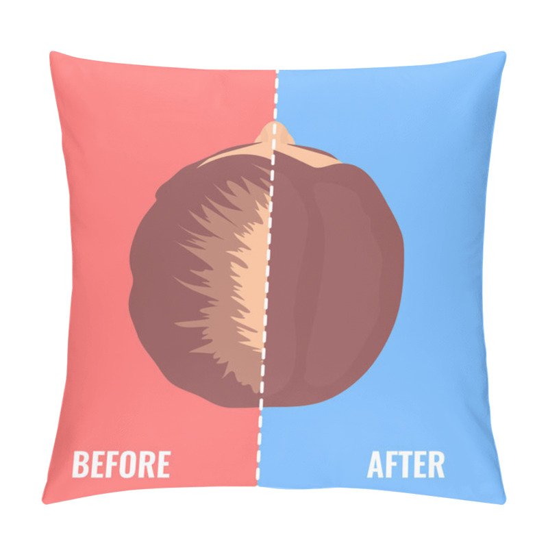 Personality  Balding Woman Before And After Hair Transplantation Pillow Covers