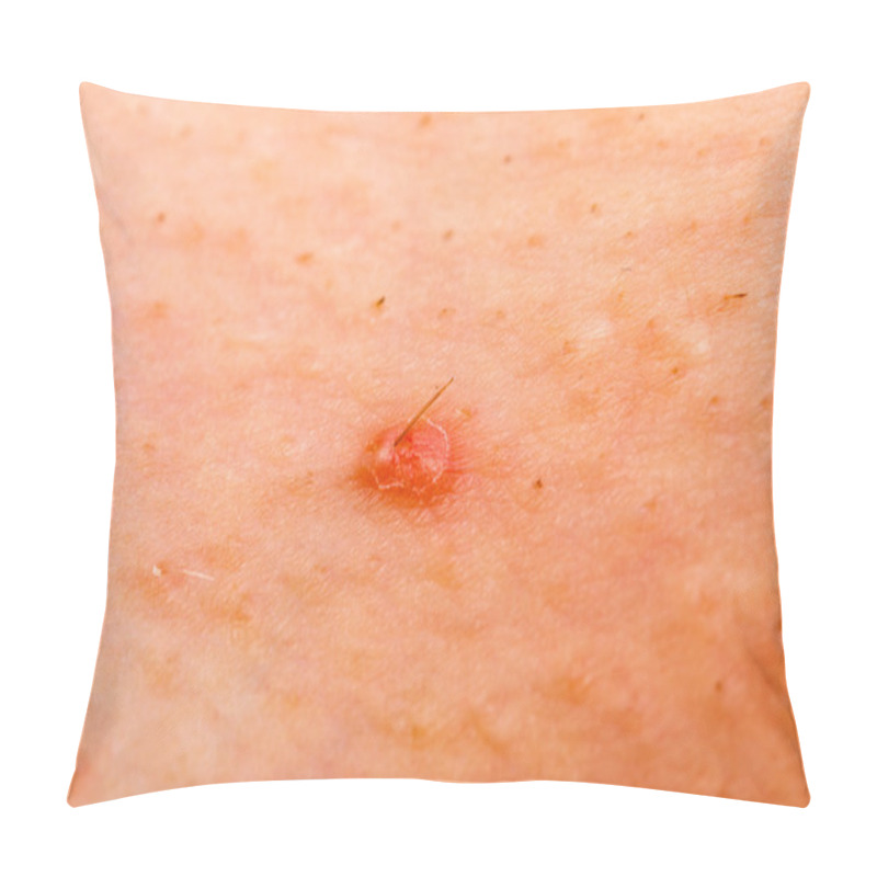 Personality  Acne Skin Pillow Covers