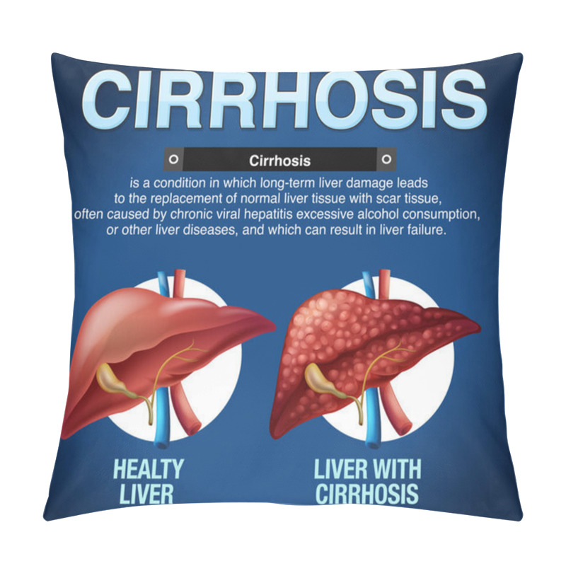 Personality  Cirrhosis Of The Liver Infographic Illustration Pillow Covers