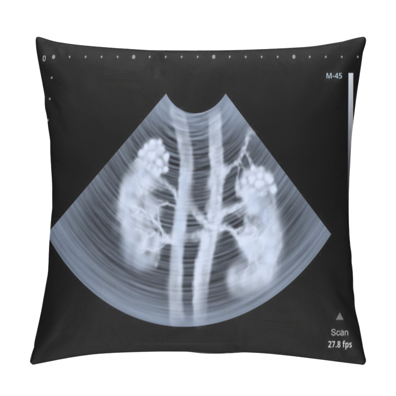 Personality  Ultrasound Scan Of Human Kidneys. Illustration Pillow Covers