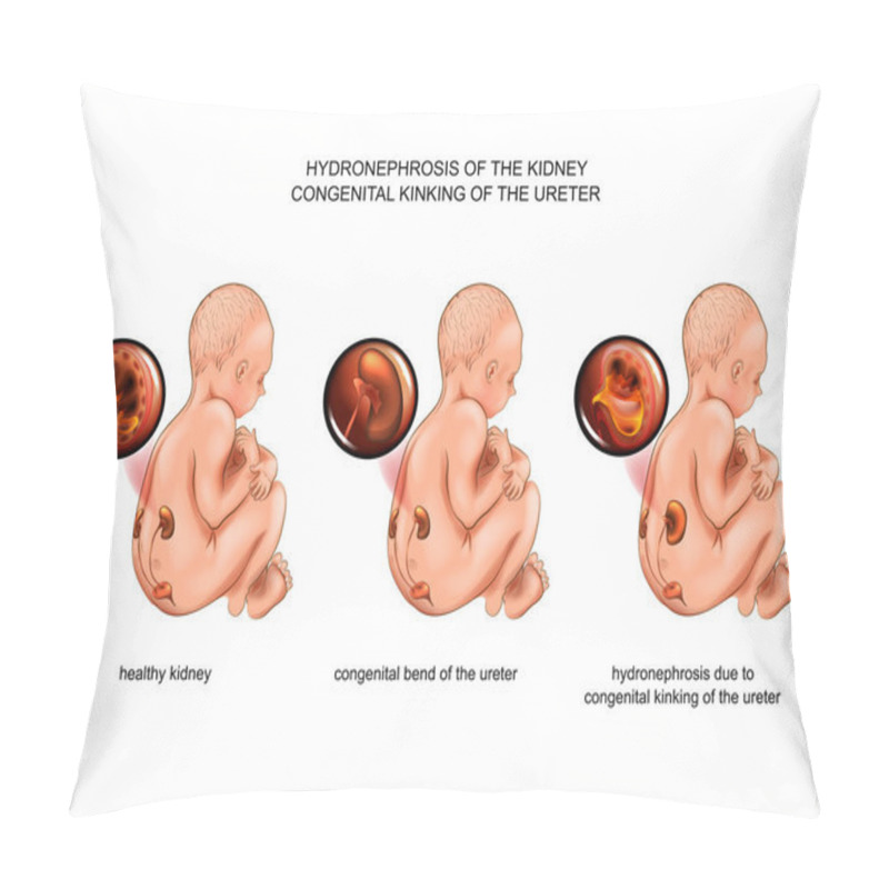 Personality  Vector Illustration Of Hydronephrosis Due To Congenital Ureteral Curvature Pillow Covers