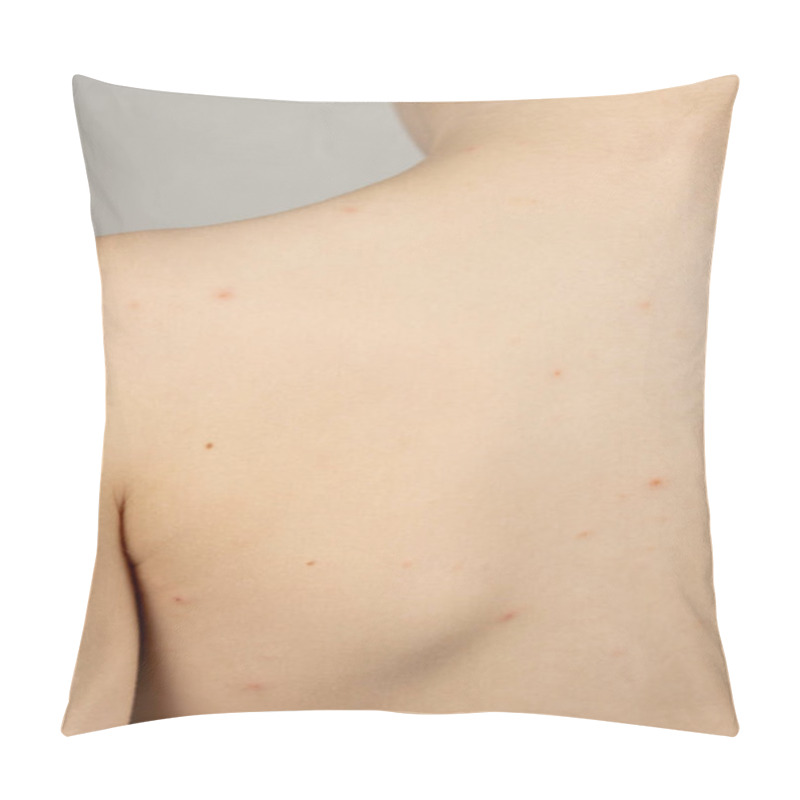 Personality  The Skin Of A Child Affected By Chickenpox, Vesicles At Different Stages Of Development Pillow Covers