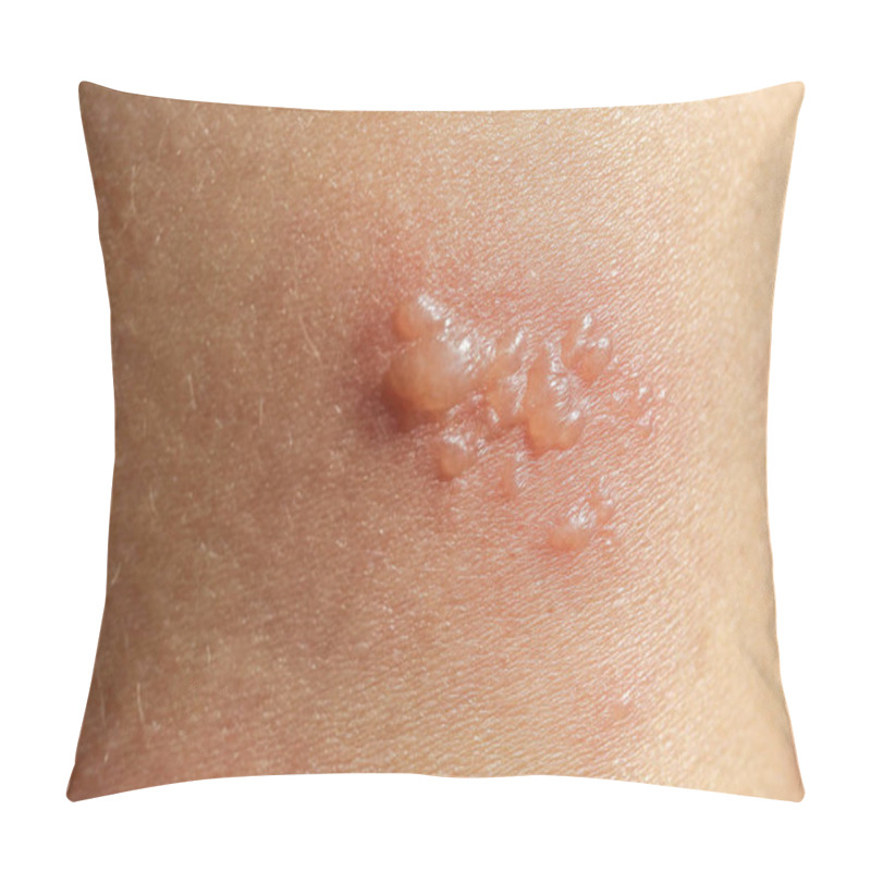 Personality  Skin Rash As Allergic Symptoms Due To Arm Fiberglass Cast Pillow Covers