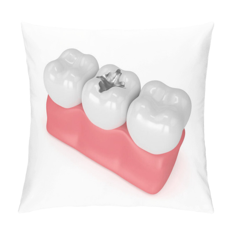 Personality  3d Render Of Teeth With Dental Amalgam Filling Pillow Covers