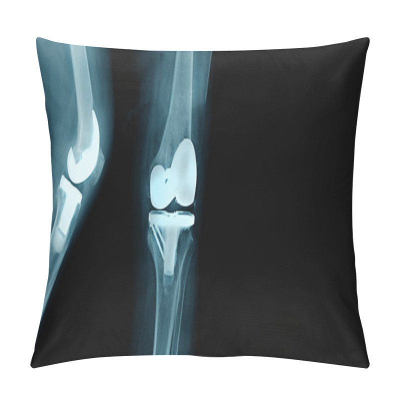 Personality  Total Knee Replacement, Website And Printing Use Pillow Covers