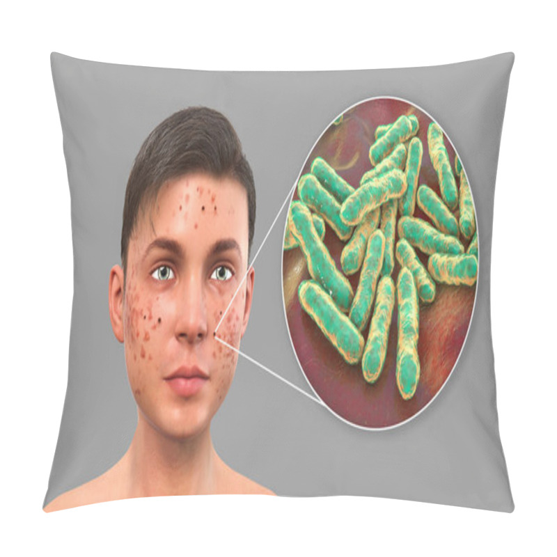 Personality  Acne Vulgaris In A Teenager Boy And Closeup View Of Bacteria Cutibacterium Acnes, Formely Formerly Propionibacterium Acnes, Associated With Acne Development, 3D Illustration Pillow Covers