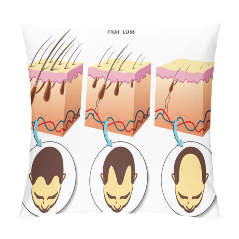 Personality  Hair Loss Process Pillow Covers