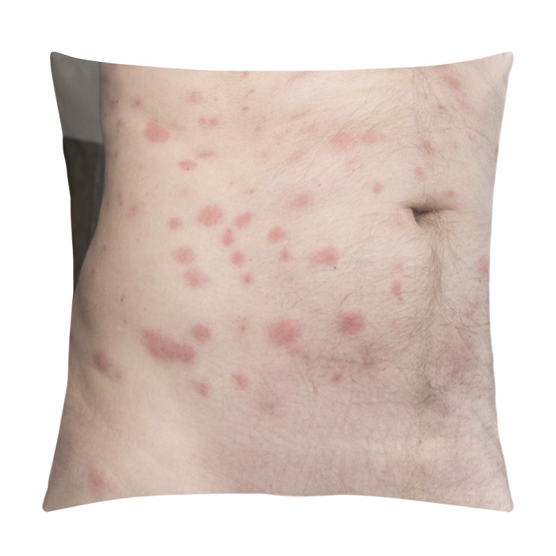 Personality  Bites Of Insect On Male Body. Bed Bugs Or Flea. Pillow Covers