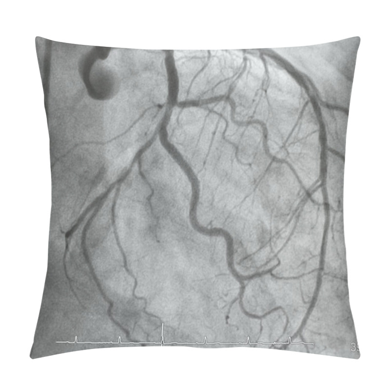 Personality  Coronary Angiography , Left Coronary Angiography Pillow Covers