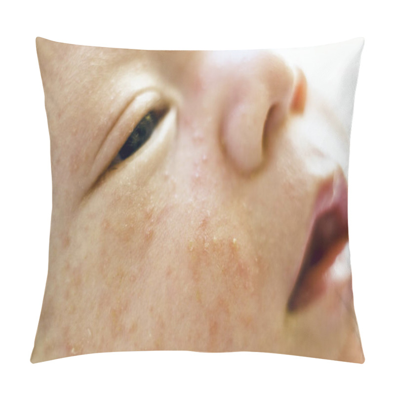 Personality  Newborn Baby Boy Face With Many Pimples Caused By Atopic Dermatitis Pillow Covers