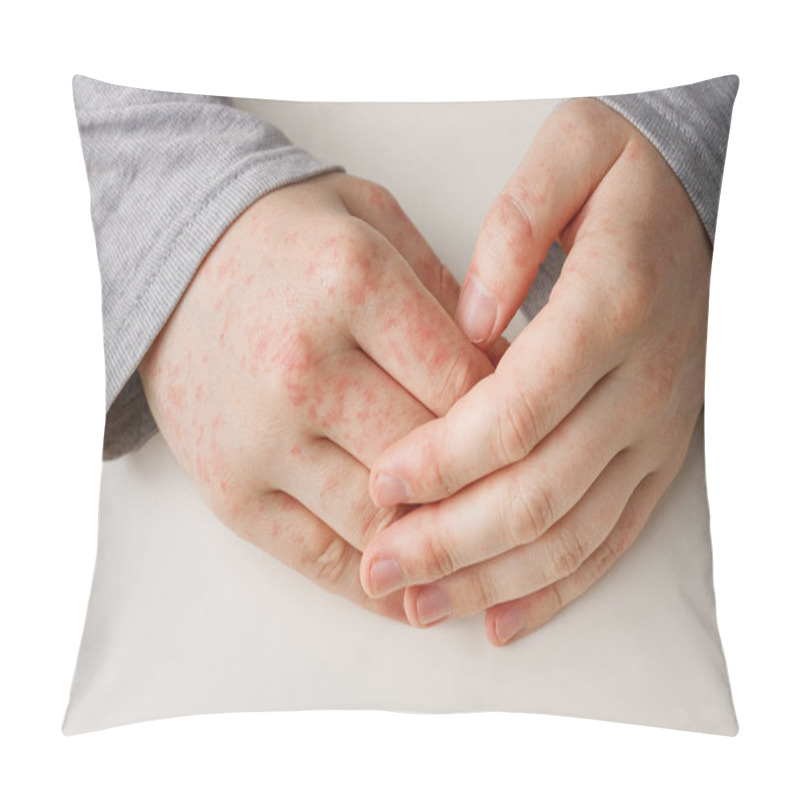 Personality  Male Hands On White Table With Red Spots On Skin. Allergic Reaction, Skin Problems, Dermatology. Wrong Diet, Side Effect From Taking Meds Pillow Covers