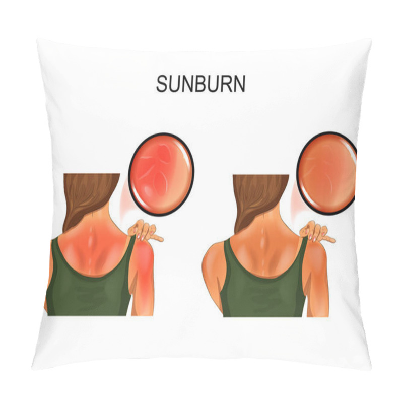 Personality  Sunburn Skin. Tan On The Girls Back Pillow Covers