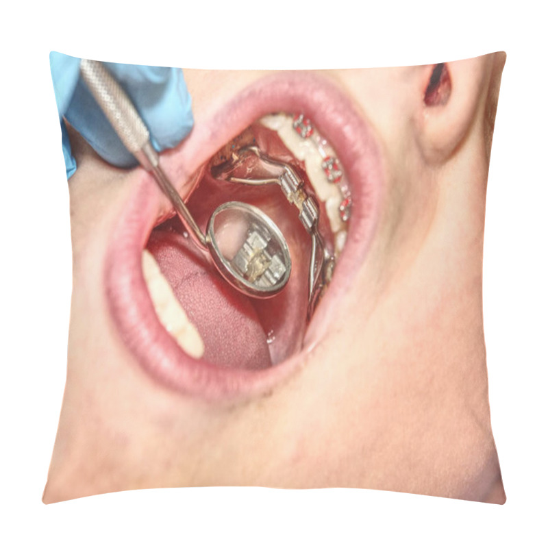 Personality  Prague, Czech Republic September 28th 2018. The Hyrax (Hygienic Rapid Expander) Banded Designed As An Upper Arch Rapid Palatal Expanding Appliance. Pillow Covers