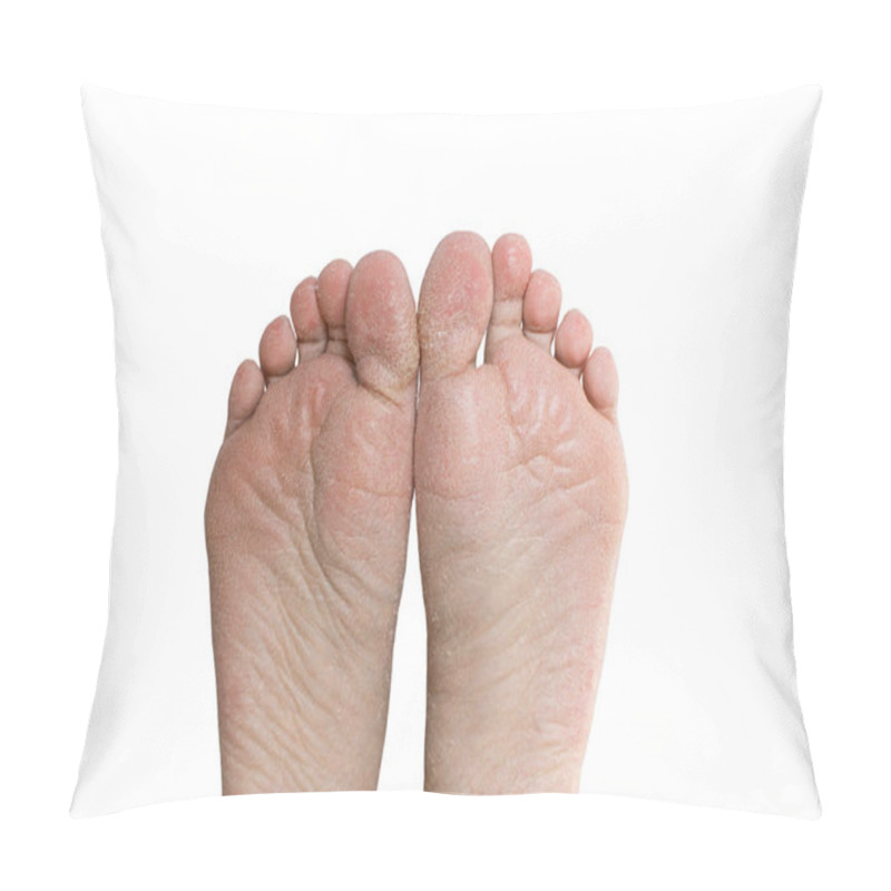 Personality  Close Up Cracked Heels. Health Problems With Skin On Feet Pillow Covers