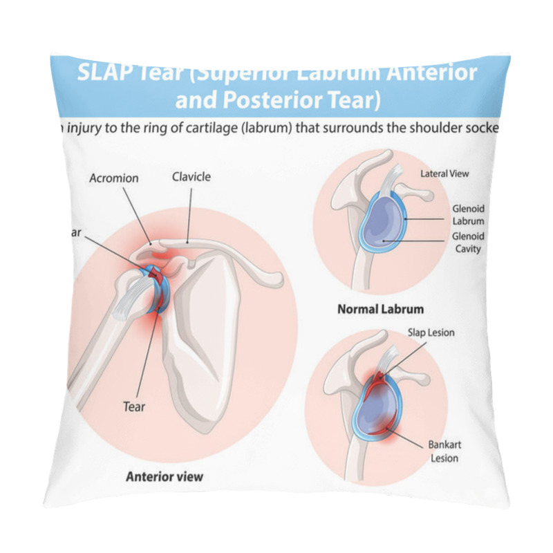 Personality  Detailed Diagram Of Shoulder Labrum Tears Pillow Covers