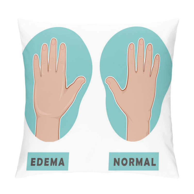 Personality  Swollen Hand And Normal Hand. Edema And Lymphedema. Vector Illustration Of The Disease Before-after. Pillow Covers