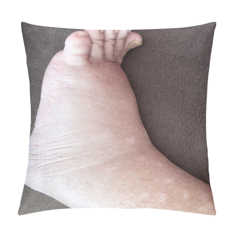 Personality  Closeup Foot Of Diseased Female Patient Who Suffers From Edema Illness Pillow Covers