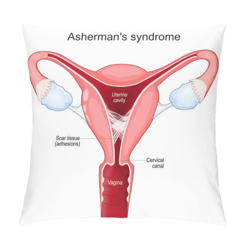 Personality  Asherman's Syndrome. Cross Section Of Uterine With Adhesions. Scar Tissue In The Uterine Cavity. Intrauterine Synechiae. Problems Of Infertility. Female Reproductive System. Vector Poster Pillow Covers