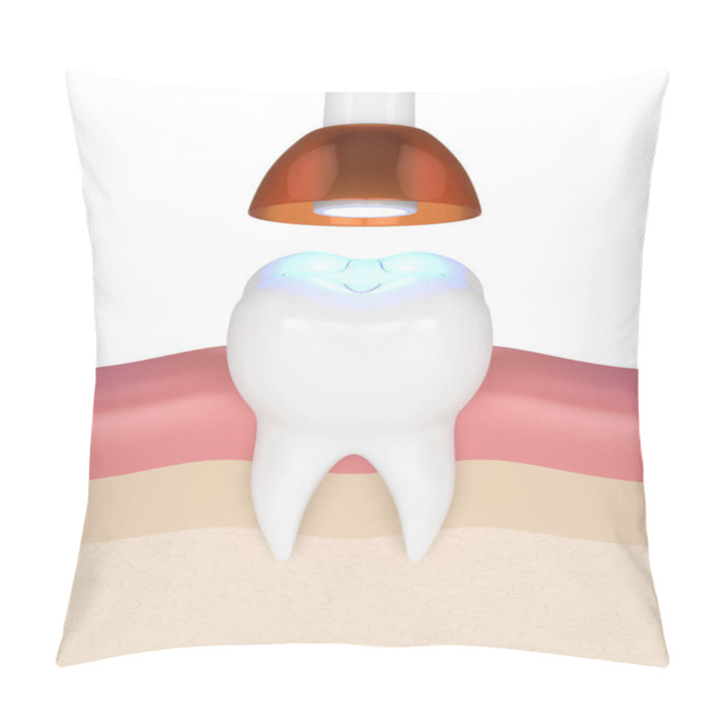 Personality  3d Render Of Tooth With Dental Polymerization Lamp And Light Cured Inlay Filling Over White Background Pillow Covers