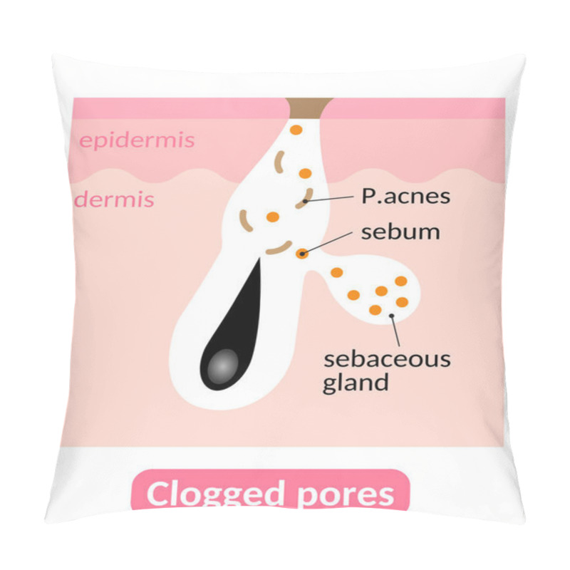 Personality  Sebum Plugs Causes Clogged Pores, Which Lead To Acne. Skin Care Concept Pillow Covers