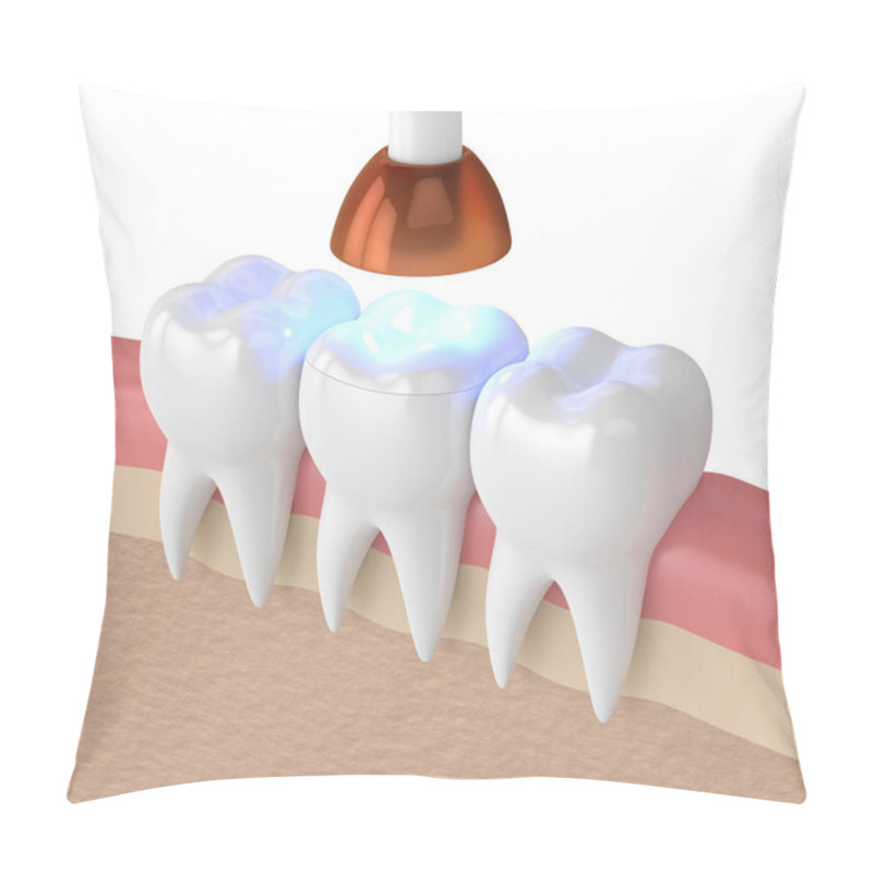 Personality  3d Render Of Teeth With Dental Polymerization Lamp And Light Cured Onlay Filling Over White Background Pillow Covers