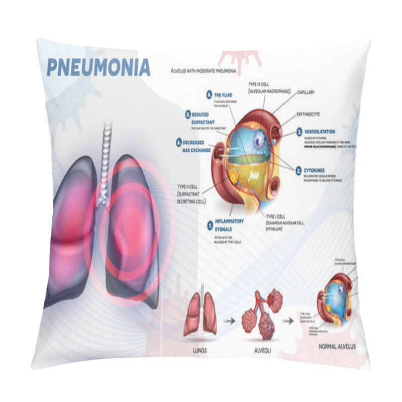 Personality  Pneumonia Explained Info Poster, Body Immune Response, Human Lungs And Detailed Alveolus Anatomy Illustration Pillow Covers