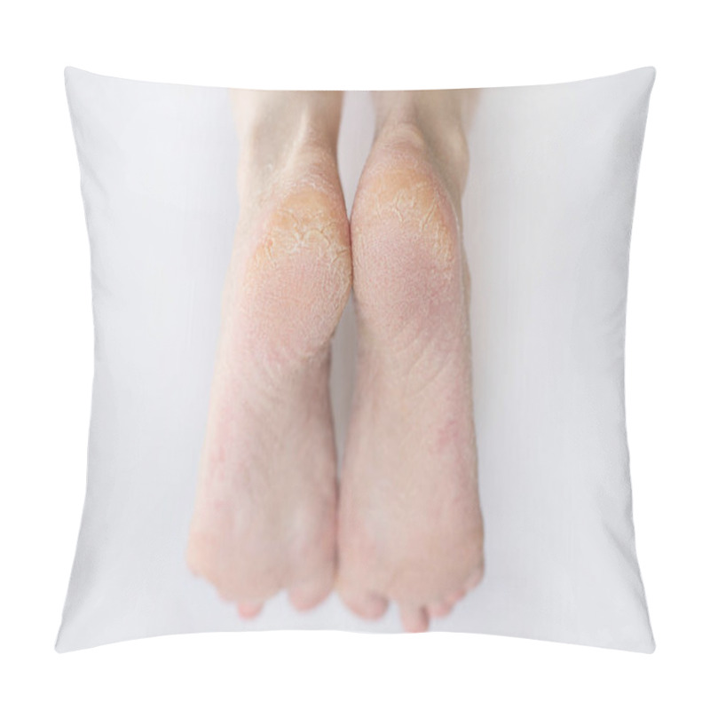 Personality  Close Up Cracked Heels. Health Problems With Skin On Feet Pillow Covers