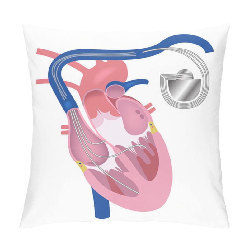 Personality  Pacemaker. Heart In Longitudinal Section. Vector Medical Illustration Pillow Covers