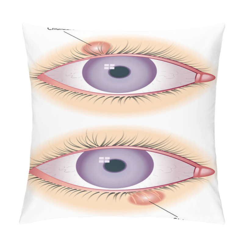 Personality  Chalazion & Sty Pillow Covers