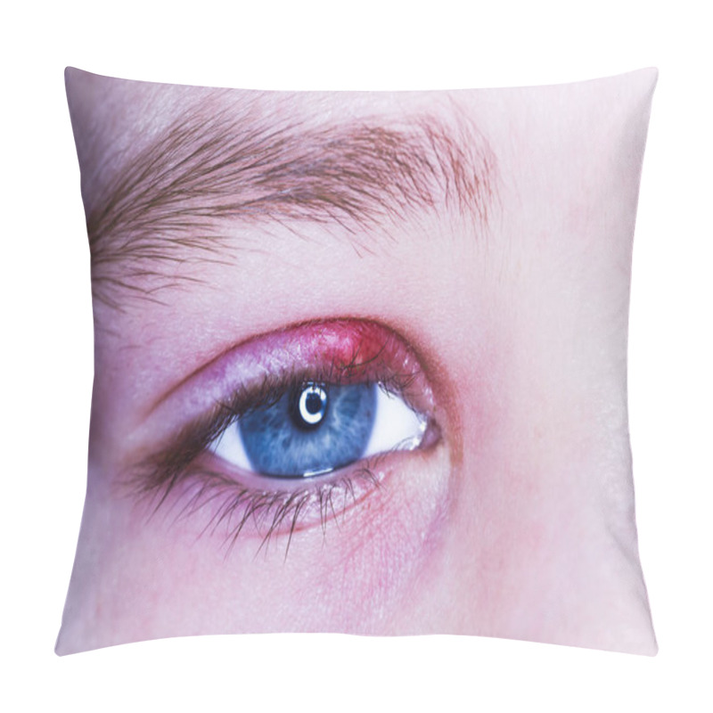 Personality  Stye Kid Eye Red Skin Barley Bacteria Virus Pillow Covers