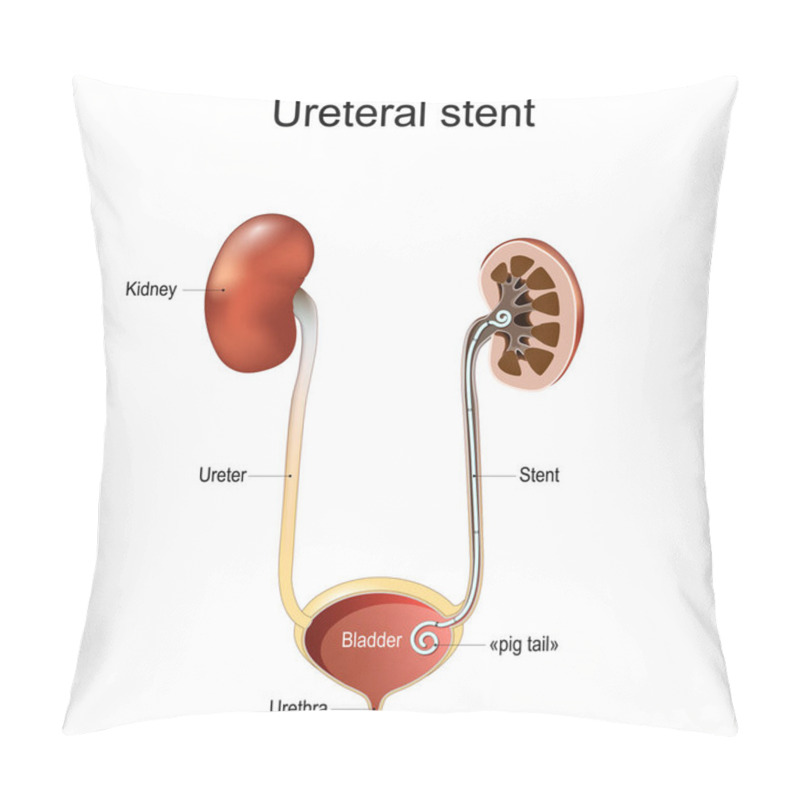 Personality  Ureteral Stent. Renal Colic. Human Urinary System. Cross Section Of A Kidney And Bladder With Pig-tail Stent. Vector Illustration Isolated On White Background. Pillow Covers