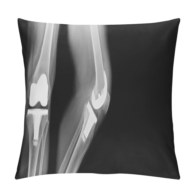 Personality  TKA X-ray, Total Knee Replacement Frontal And Lateral View Pillow Covers