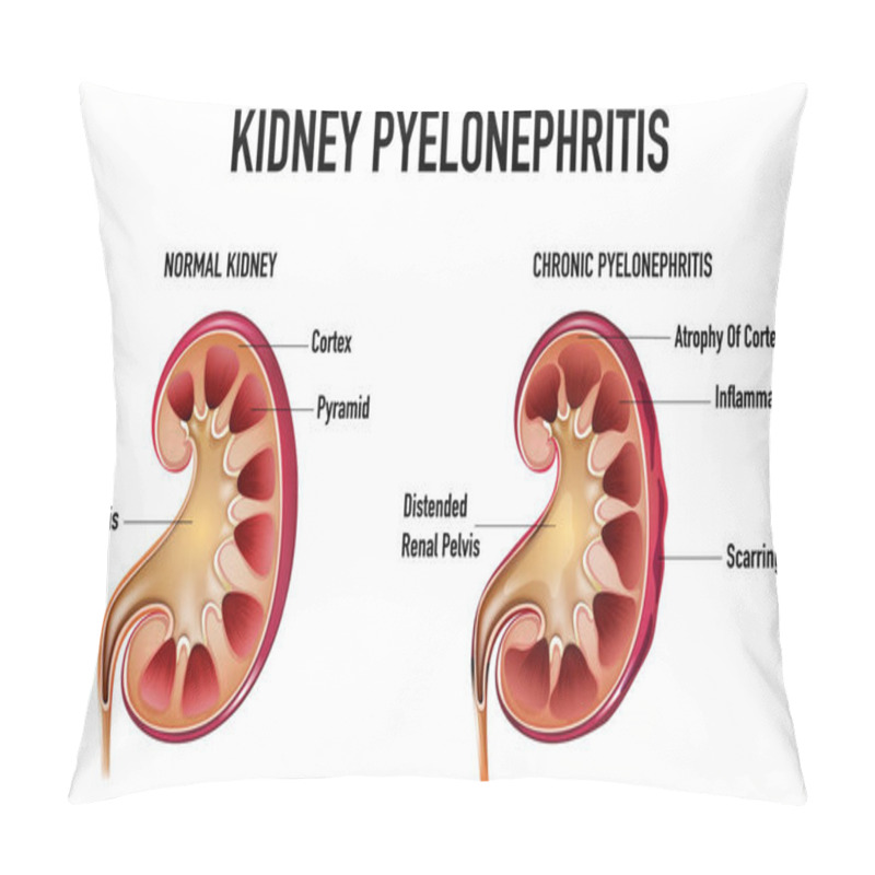 Personality  Informative Illustration Of Pyelonephritis Illustration Pillow Covers